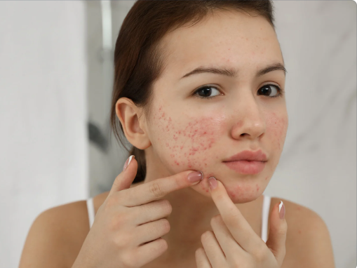 How to Get rid of Pimples at Home